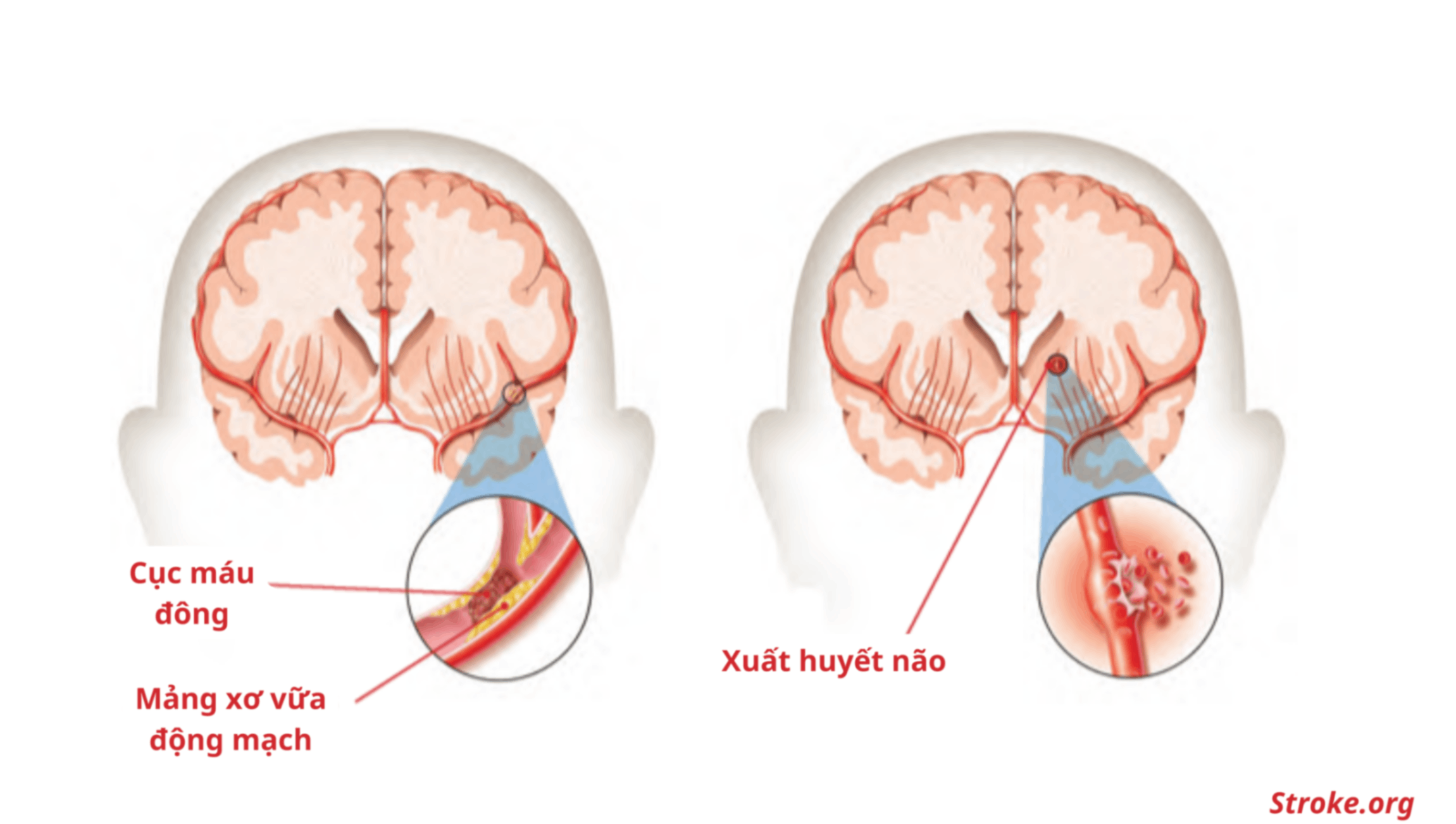 CUỘC SỐNG SAU ĐỘT QUỴ THAY ĐỔI THẾ NÀO?